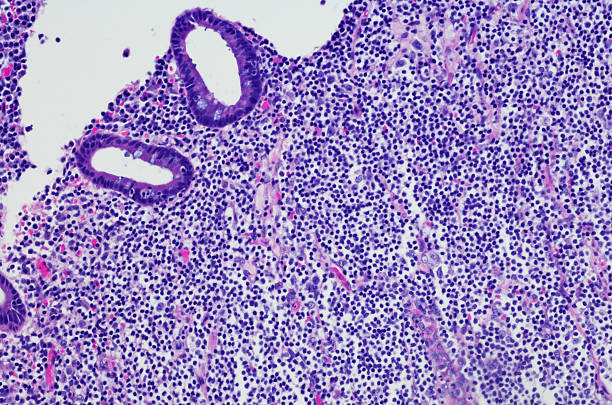 mucosa-associated lymphoid tissue (malt). non-hodgkin lymphoma - non hodgkin lymphoma imagens e fotografias de stock