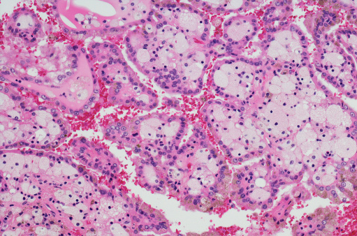 Micrograph of Renal Cell Carcinoma (RCC). Renal cell carcinoma is a kidney cancer that originates in the lining of the proximal convoluted tubule, a part of the very small tubes in the kidney that transport waste molecules from the blood to the urine. RCC is the most common type of kidney cancer in adults, responsible for approximately 90â95% of cases. Initial treatment is most commonly either partial or complete removal of the affected kidney(s). Where the cancer has not metastasised (spread to other organs) or burrowed deeper into the tissues of the kidney, the 5-year survival rate is 65â90%, but this is lowered considerably when the cancer has spread.