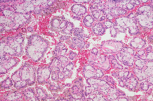 mikrograf raka nerki (rcc) - kidney cancer zdjęcia i obrazy z banku zdjęć
