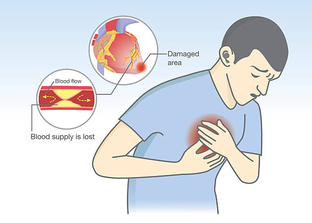 ilustrações, clipart, desenhos animados e ícones de a causa dos sintomas de ataque cardíaco do fluxo sanguíneo ficam bloqueadas. - stroke vascular symptoms patient