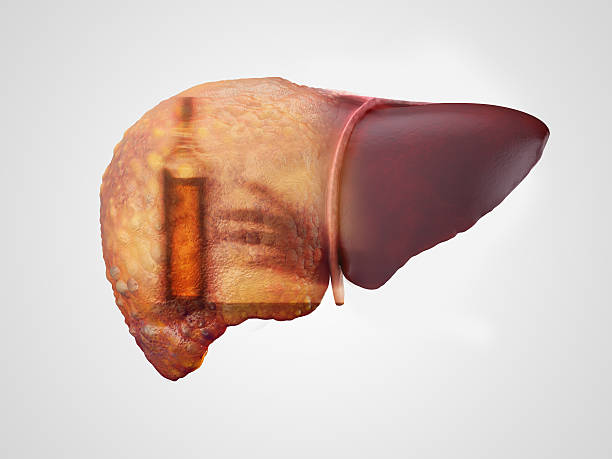 Liver and alcohol addiction double exposure Liver cirrhosis and alcohol addiction double exposure 3d illustration isolated on white liver failure stock pictures, royalty-free photos & images