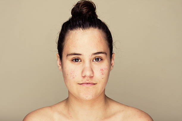 istock Teenage skin 618855864