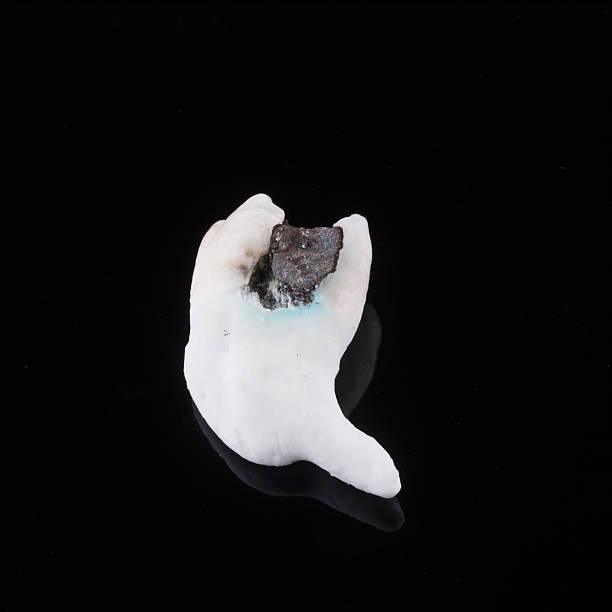 istock Single extracted tooth with filling on black background 618873838