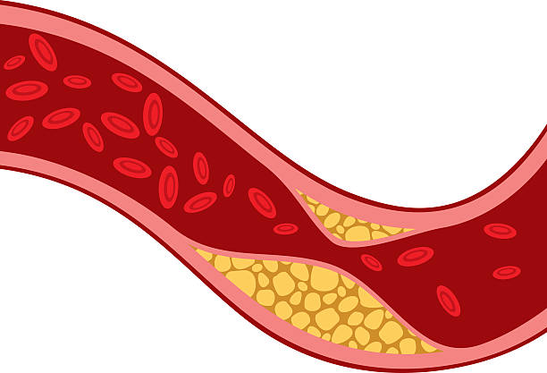 tętnicy zablokowane z cholesterolu (ciśnienie krwi, miażdżyca) - red blood cell obrazy stock illustrations