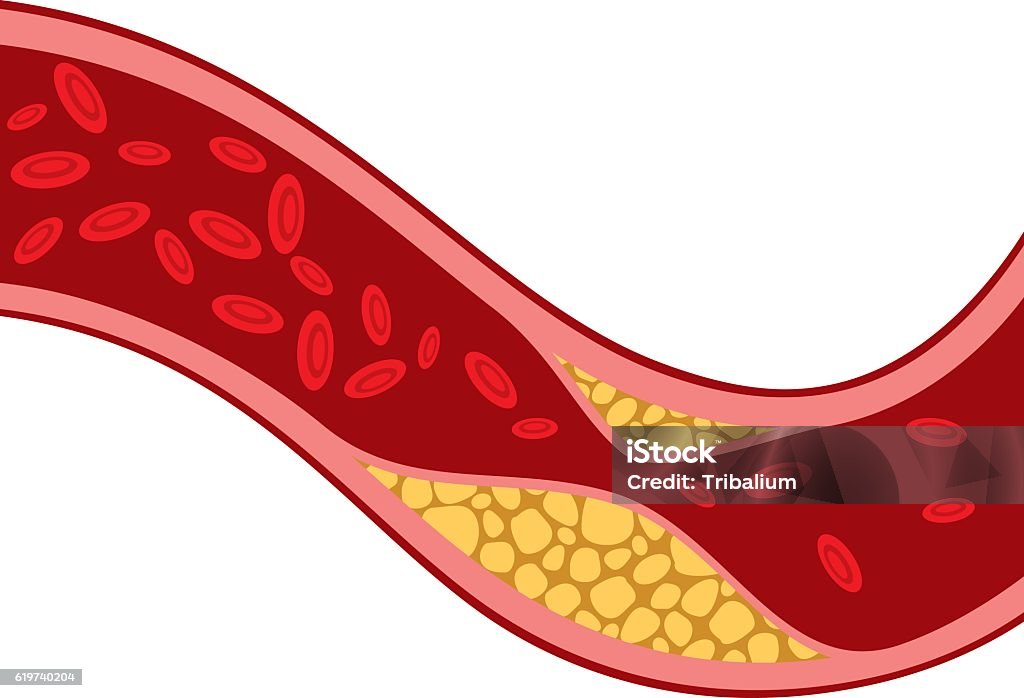artery blocked with cholesterol (blood pressure, arteriosclerosis) artery blocked with cholesterol vector illustration (blood pressure design, the structure of a vein with plaque - arteriosclerosis) Cholesterol stock vector