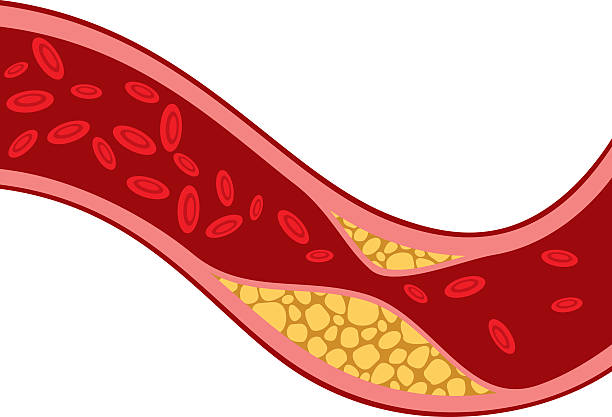 artery blocked with cholesterol (blood pressure, arteriosclerosis) artery blocked with cholesterol vector illustration (blood pressure design, the structure of a vein with plaque - arteriosclerosis) colesterol stock illustrations