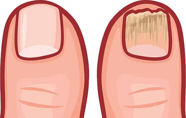 Vector illustration of fungal infection of the nails vector illustration