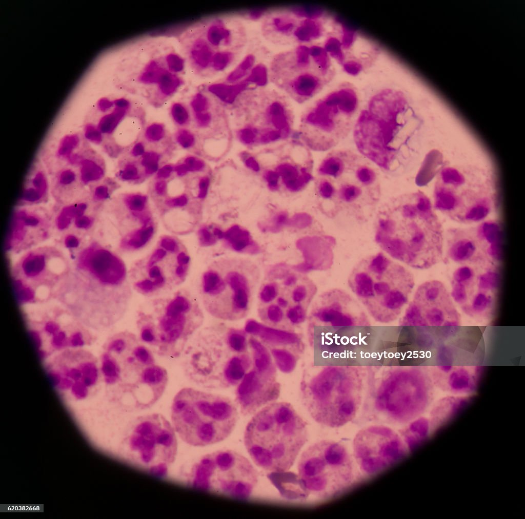 Cancer Cell in human showing abnormal cells. Arthritis Stock Photo