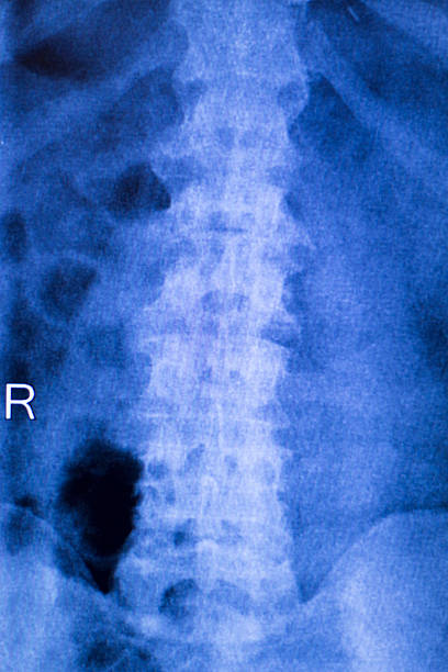 scansione a raggi x per lesioni al collo e alla colonna vertebrale - vertebral body foto e immagini stock