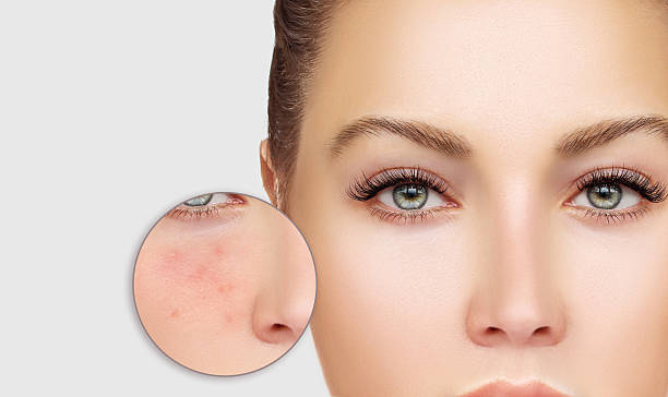 istock Girl  with problem and clear skin. 621471506