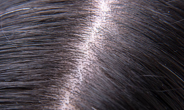 istock Hair And Scalp 621479602