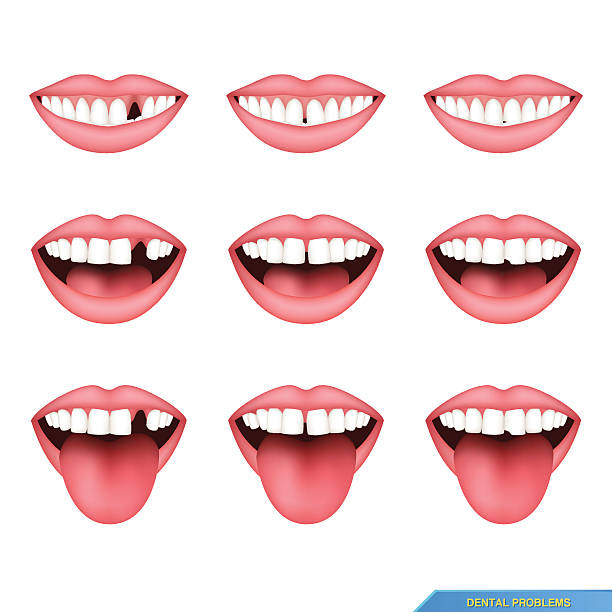 ilustrações de stock, clip art, desenhos animados e ícones de set of dental problems, missing teeth, gap between - toothless grin