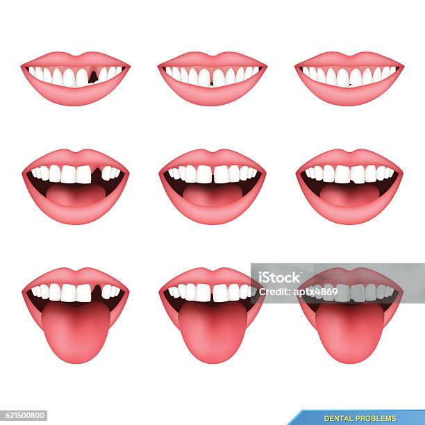 Set Of Dental Problems Missing Teeth Gap Between Stock Illustration -  Download Image Now - Gap Toothed, Smiling, Bacterium - iStock