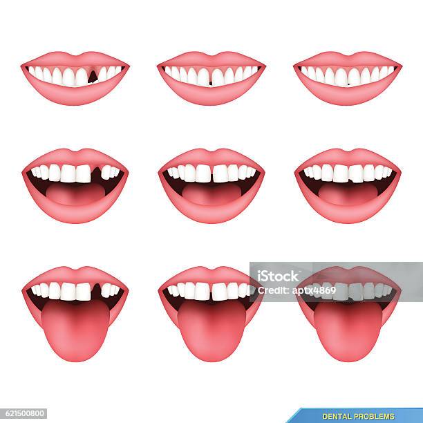 Set Of Dental Problems Missing Teeth Gap Between Stock Illustration - Download Image Now - Gap Toothed, Smiling, Bacterium - iStock Set Of Dental Problems Missing Teeth Gap Between Stock Illustration - Download Image Now - Gap Toothed, Smiling, Bacterium - iStock