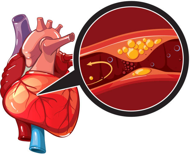 Myocardial infarction vector Myocardial infarction. Illustration of human heart in myocardial. Vector heart for banner coronary artery stock illustrations