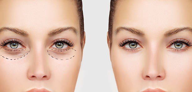 Marking the face.Lower-Eyelid Blepharoplasty Marking the face.Lower-Eyelid BlepharoplastyCorrecting the aging process.Perforation lines on females face, plastic surgery concept. corrective action stock pictures, royalty-free photos & images