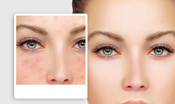 istock Girl  with problem and clear skin. 621828276