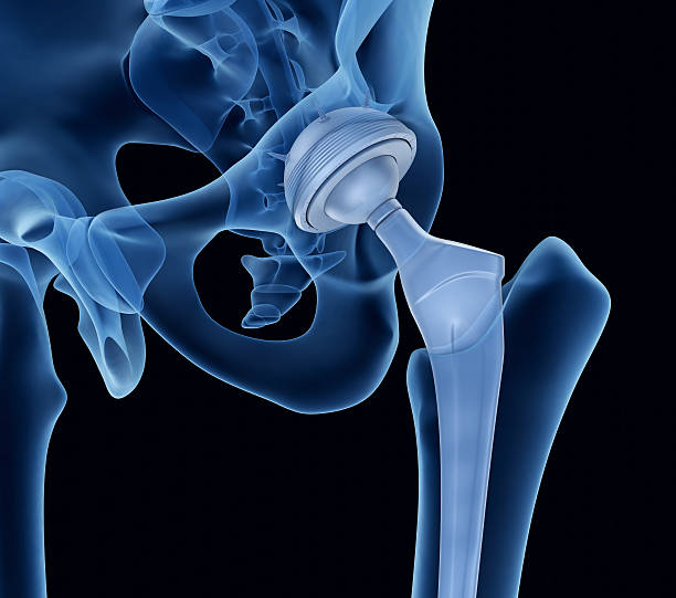 implante de reemplazo de cadera instalado en el hueso de la pelvis. vista de rayos x. - artificial metal healthcare and medicine technology fotografías e imágenes de stock