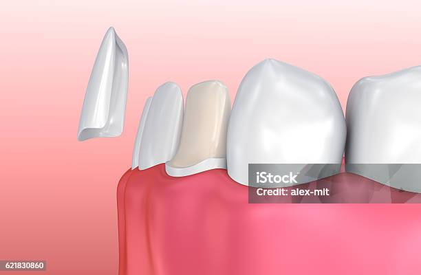 Dental Veneers Porcelain Veneer Installation Procedure Stock Photo - Download Image Now