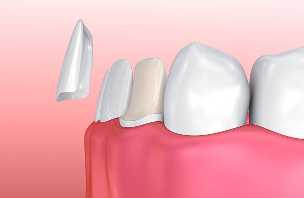 dental veneers: porcelain veneer installation procedure. - recreate imagens e fotografias de stock