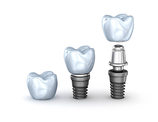 implants dentaires fixés isolés sur fond blanc illustration 3d - artificial metal healthcare and medicine technology photos et images de collection