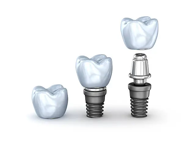 Photo of Tooth Implants set isolated on white background 3D illustration