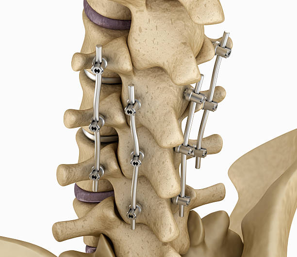 sistema di fissazione spinale - staffa in titanio. - human spine chiropractor three dimensional shape healthcare and medicine foto e immagini stock