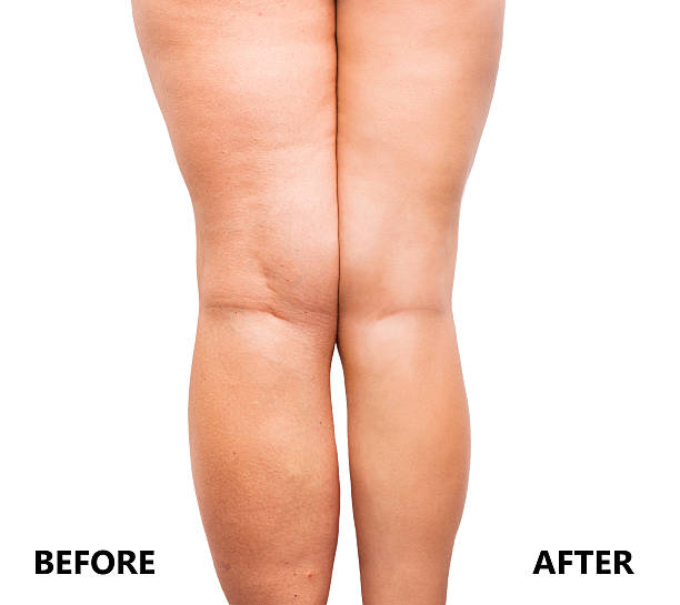 체중 감량 전후의 여성의 다리 - emaciated weight scale dieting overweight 뉴스 사진 이미지