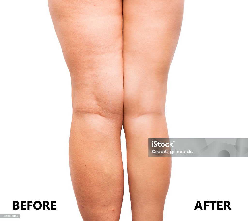 Woman's legs before and after weight loss Cellulite Stock Photo