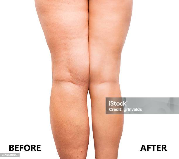 Womans Legs Before And After Weight Loss Stock Photo - Download Image Now - Cellulite, Before and After, Make Over Series