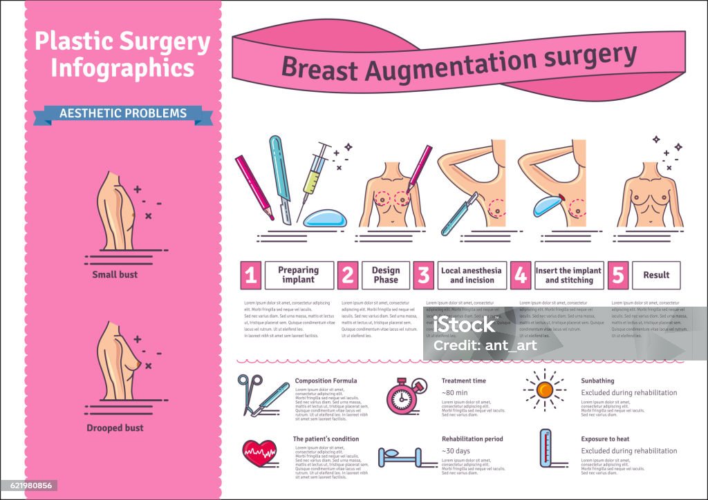 Vector Illustrated set with breast augmentation surgery Vector Illustrated set with breast augmentation surgery. Infographics with icons of plastic surgery procedures. Breast Implant stock vector