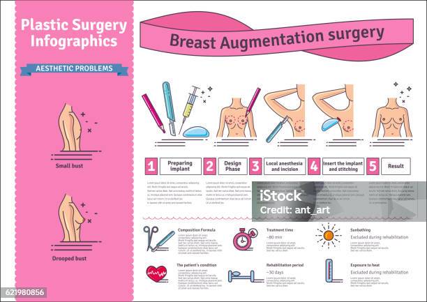 Vector Illustrated Set With Breast Augmentation Surgery Stock Illustration - Download Image Now