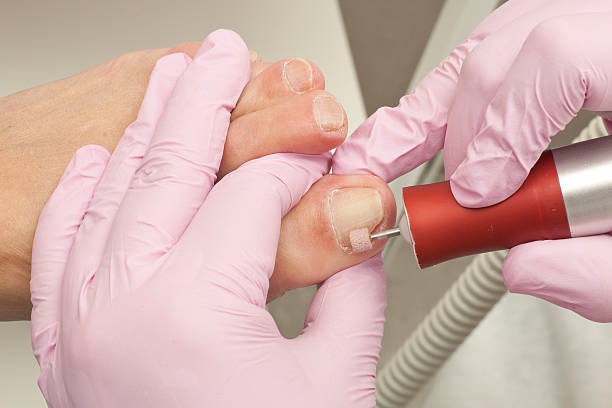 ドクターポディアトリーは、カルス、トウモロコシ、そして巻き込まれた爪を取り除きます。 - pedicure podiatrist human foot toenail ストックフォトと画像