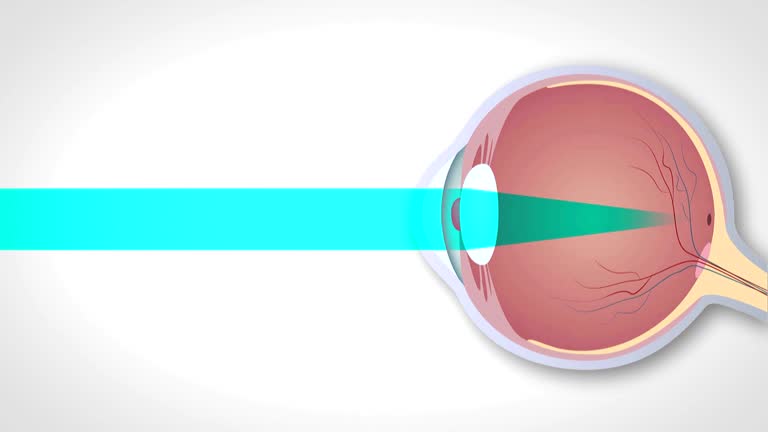 Schematic representation of hyperopia, myopia and astigmatism