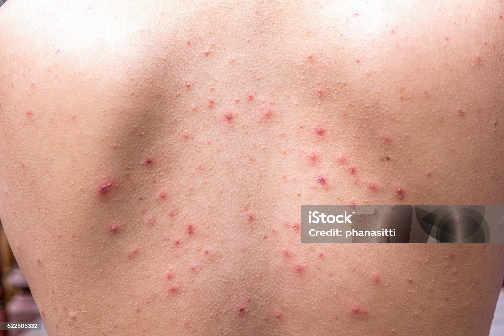 Detail with chicken pox rash at the back of body Acne Stock Photo