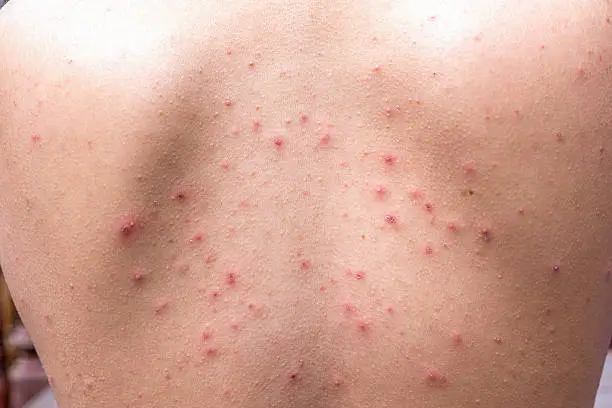 Photo of Detail with chicken pox rash at the back of body