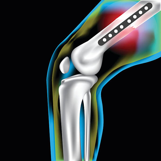 ilustrações de stock, clip art, desenhos animados e ícones de bone knee welt steel - human bone the human body healthcare and medicine human skeleton