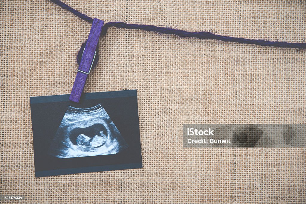 Medical images collage of ultrasound during woman pregnancy show Medical images collage of ultrasound during woman pregnancy showing fetus in third month and stetoscope on white background Abortion Stock Photo