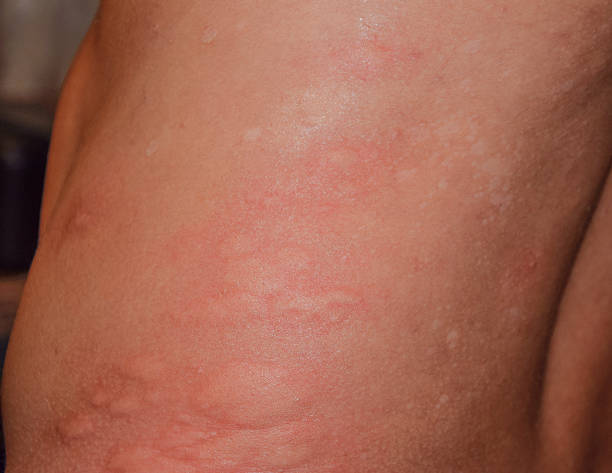 istock Allergy skin back and sides 623267798