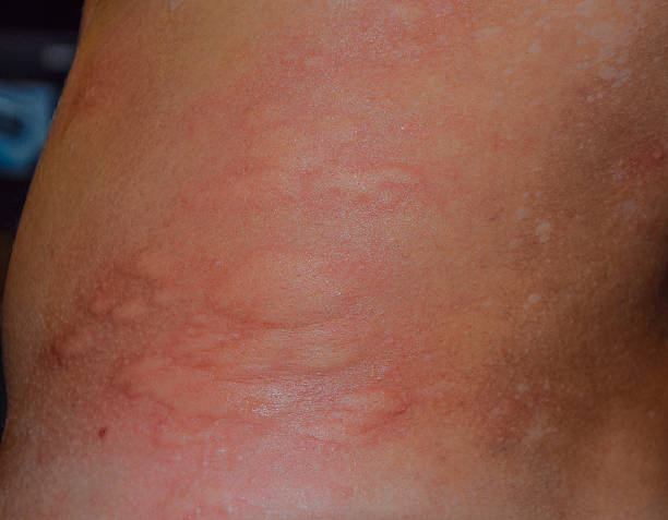 istock Allergy skin back and sides 623268218