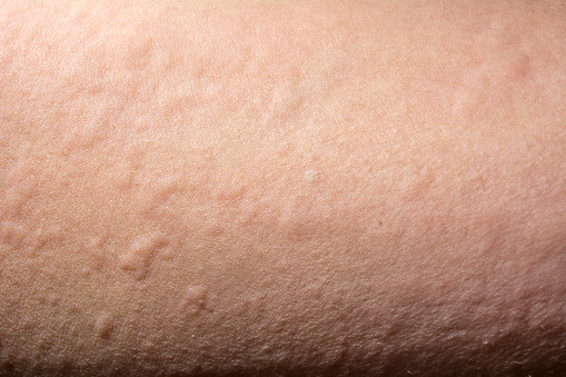Urticaria O Sarpullido De Alergia Foto de stock y más banco de imágenes