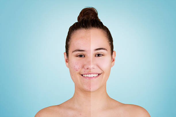 Acne before and after Problematic teenage skin before and after treatment.  pimple photos stock pictures, royalty-free photos & images