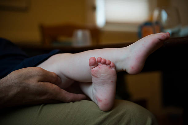 Baby with Hand, Foot, and Mouth Disease A father holds his baby girl who has Hand, Foot, and Mouth Disease, which is a comon infection caused by a group of viruses. hand foot and mouth disease stock pictures, royalty-free photos & images
