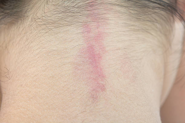 istock Rash of allergies 623380226