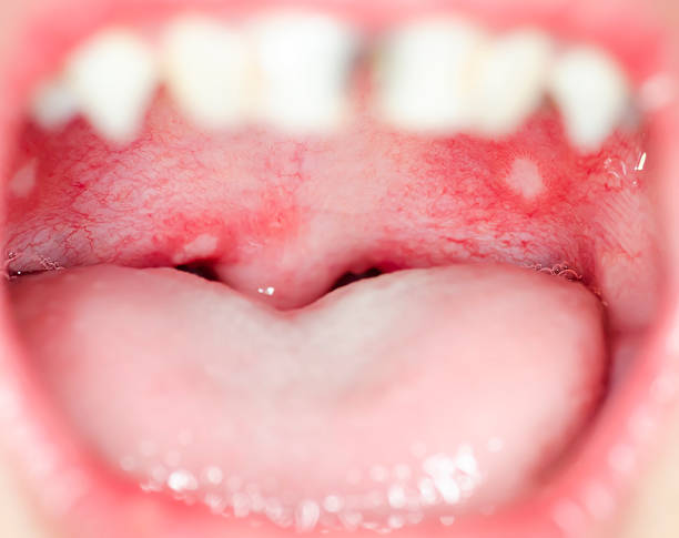 istock Infection of ulcer inside mouth 623496878