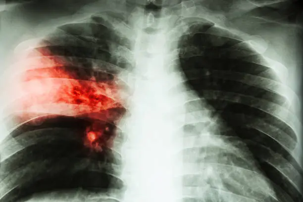 Lobar pneumonia . film chest x-ray show alveolar infiltration at right middle lobe due to tuberculosis infection .