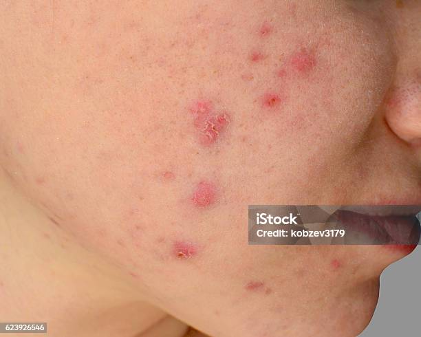 Foto de Acne Da Pele Humana e mais fotos de stock de Acne - Acne, Espinha Cutânea, Vírus da varíola