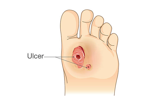 diabetische fußschmerzen und geschwüre. - pain physical injury human leg human muscle stock-grafiken, -clipart, -cartoons und -symbole