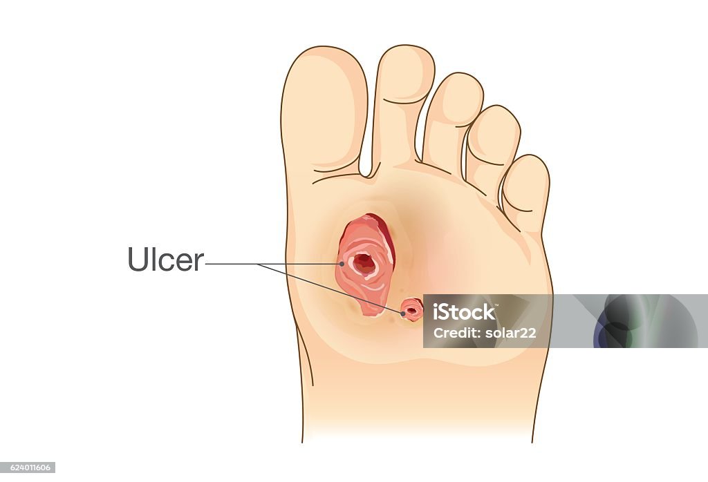 Diabetic Foot Pain and Ulcers. Diabetic Foot Pain and Ulcers. Skin Sores on Foot. Illustration about Diabetes Symptoms. Ulcer stock vector