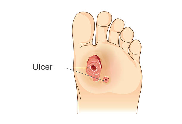 Diabetic Foot Pain and Ulcers. Diabetic Foot Pain and Ulcers. Skin Sores on Foot. Illustration about Diabetes Symptoms. skin exame stock illustrations